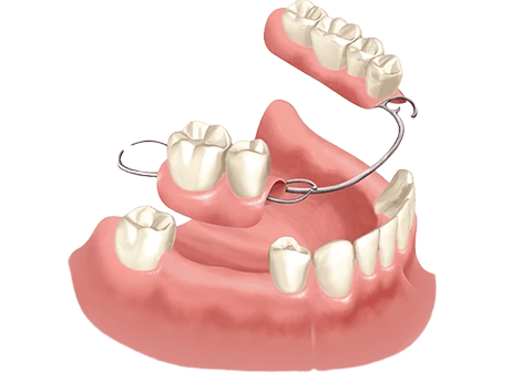 Removable