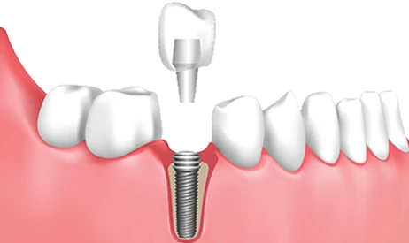 Implant