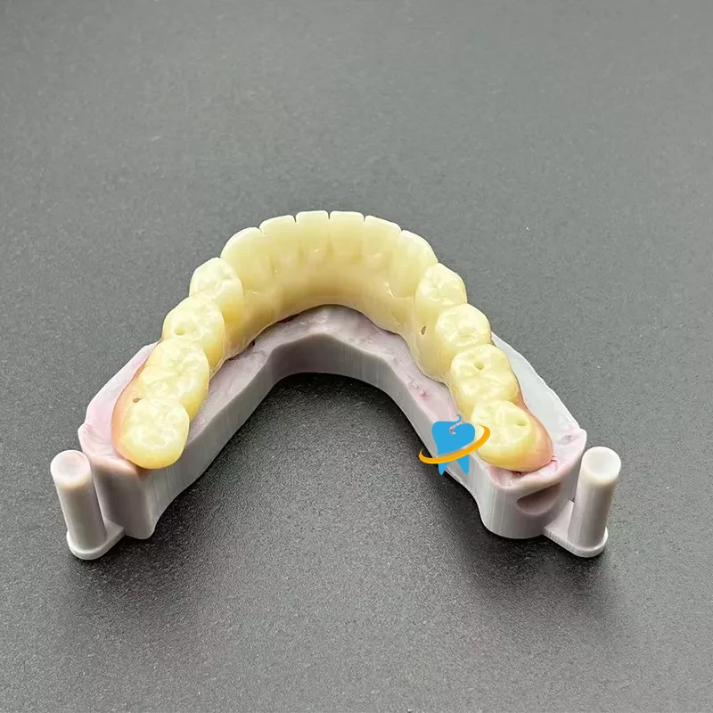 Advantages of Dental Implants