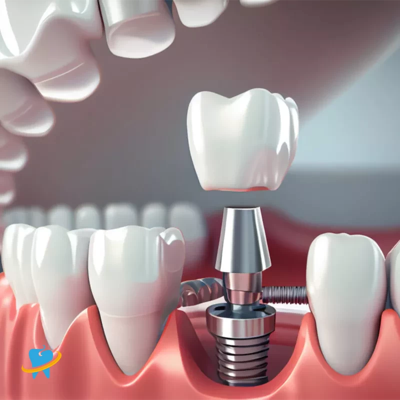Advantages of Dental Implants