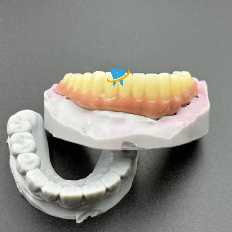 Advantages of Dental Implants