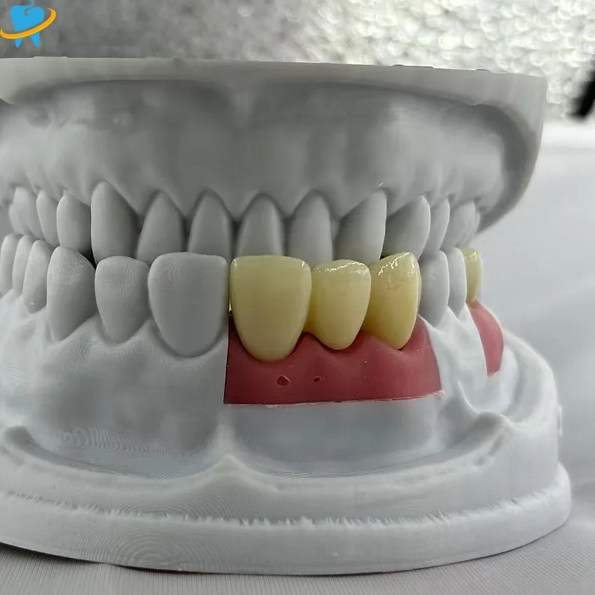 Realistic Full Zirconia Implant Crowns Manufacturer