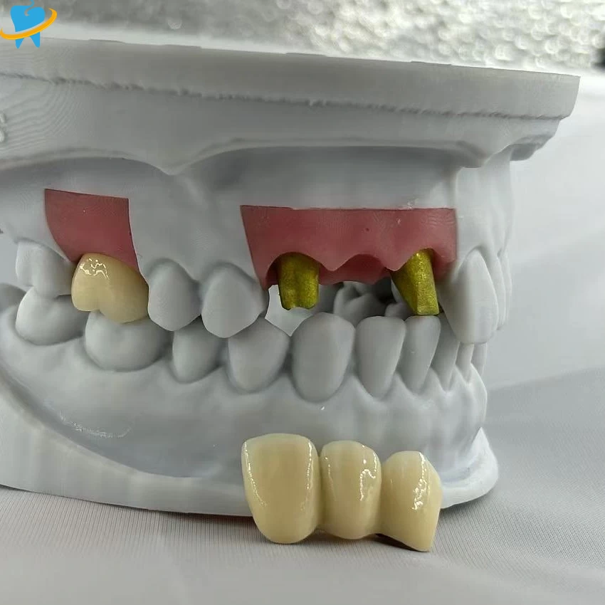 Trusted PFM Implant Crown Distributor