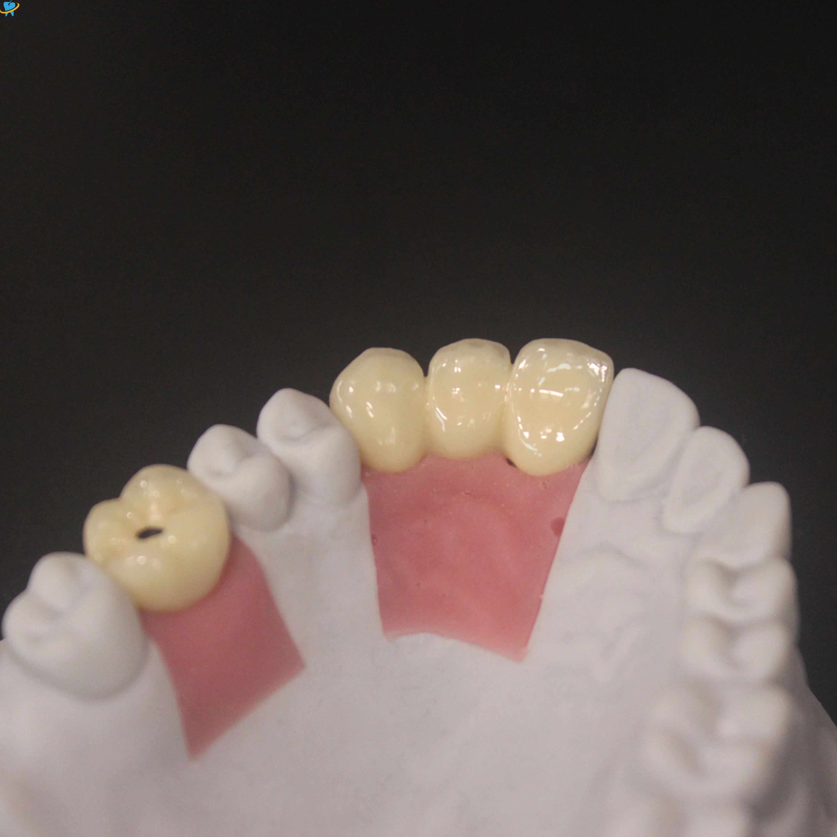 Trusted PFM Implant Crown Distributor