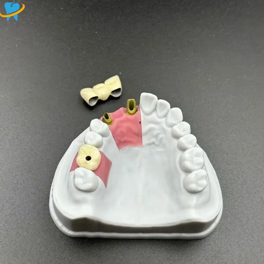 Implant PFM crown
