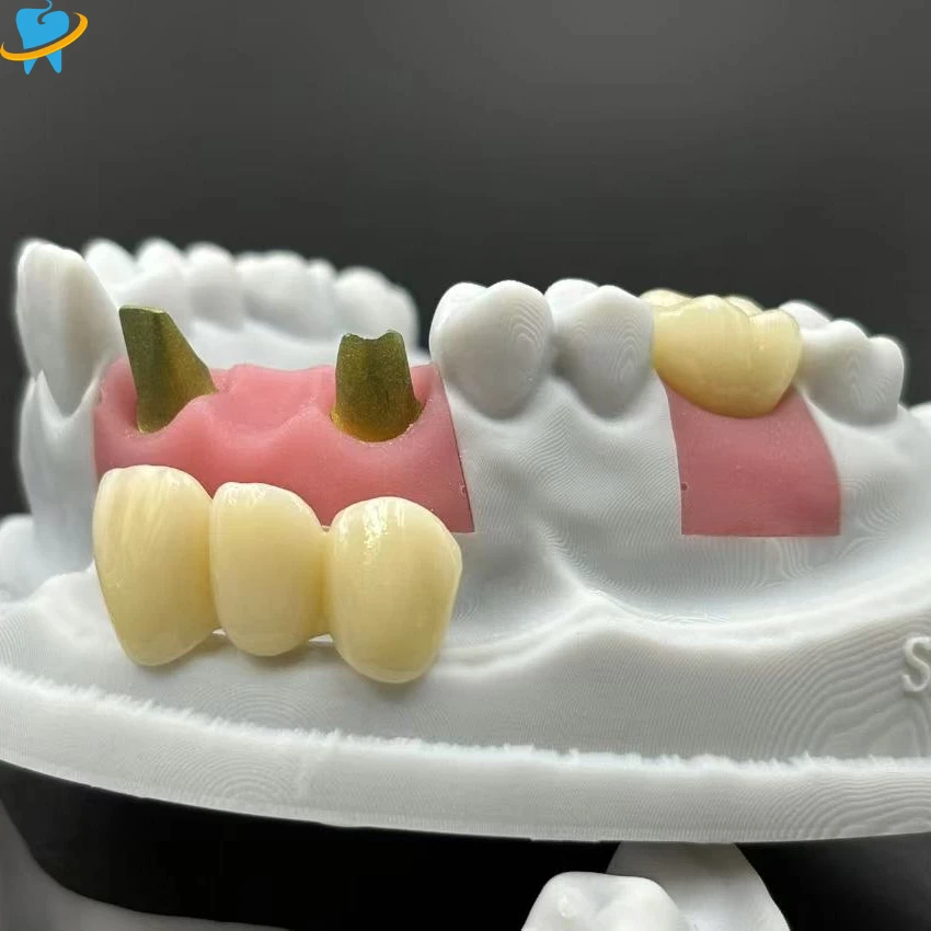 Custom Implant PFZ Crown Manufacturer