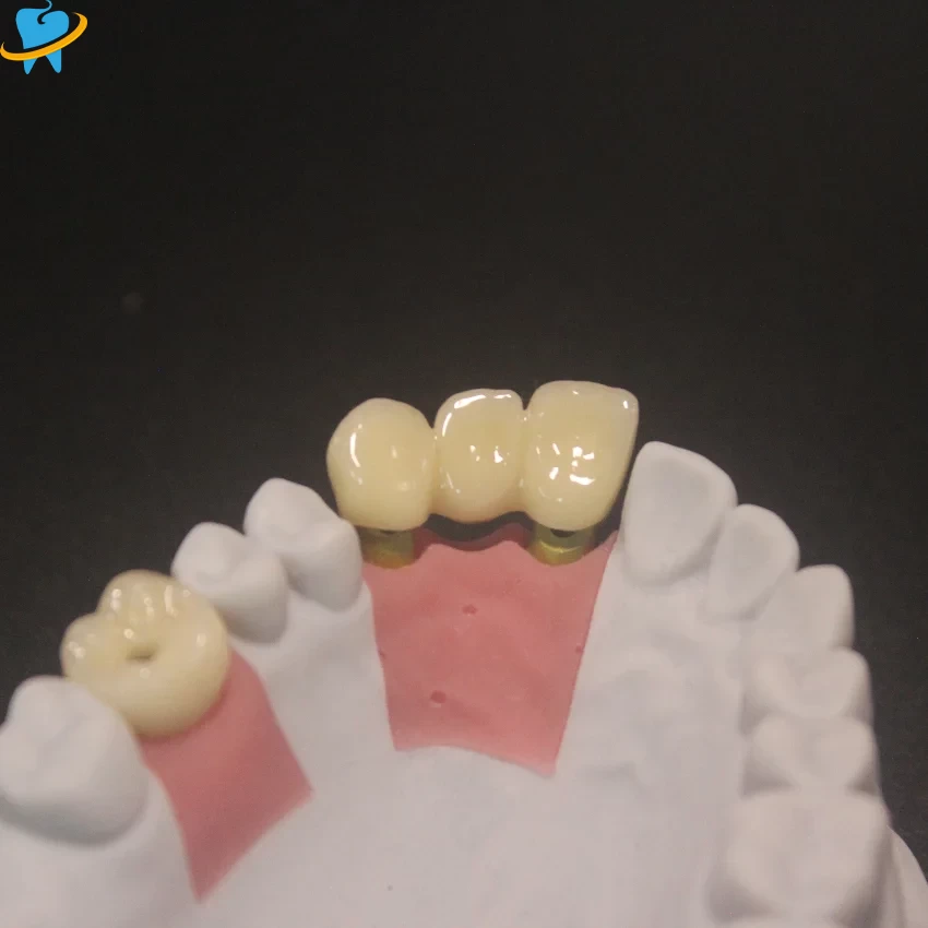 Custom Implant PFZ Crown Manufacturer