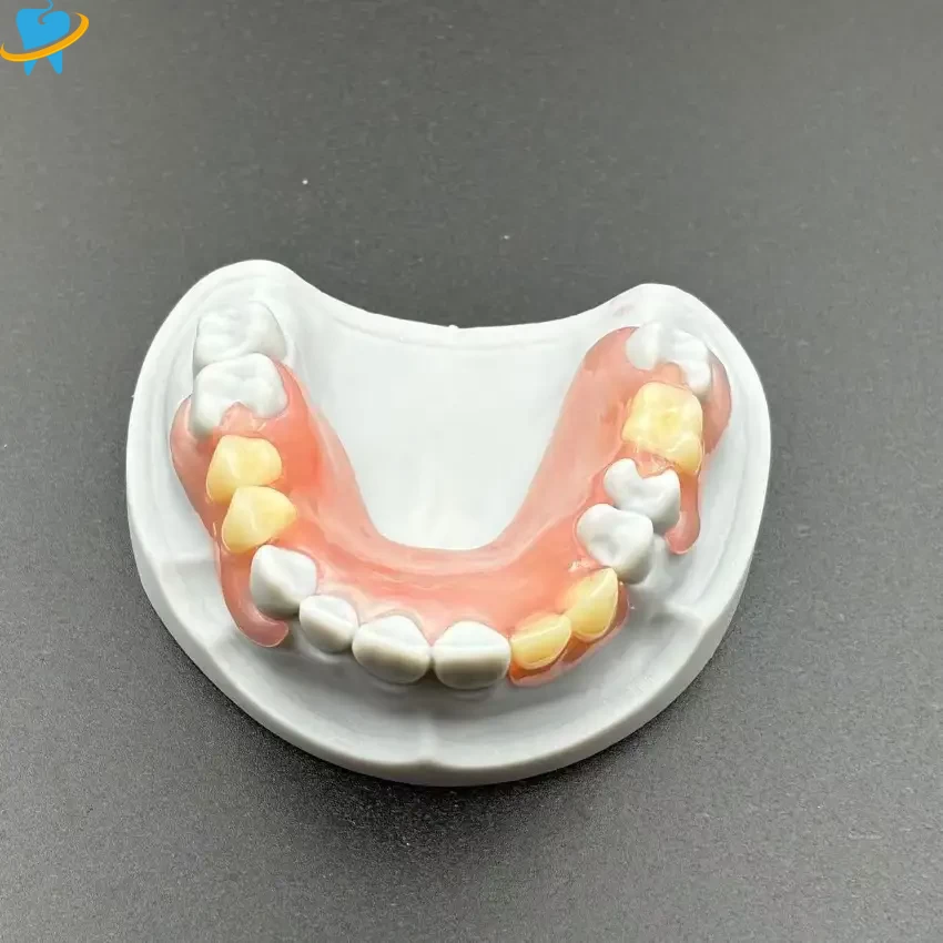 removable-valplast