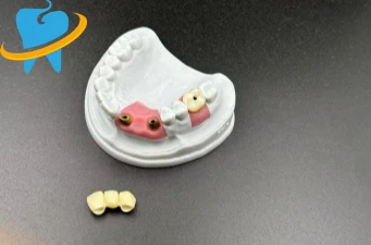 Full Zirconia Implant Crowns Manufacturer
