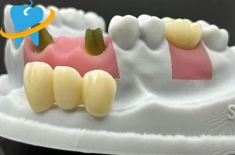 The Excellence of Star Dental's PFZ Crowns