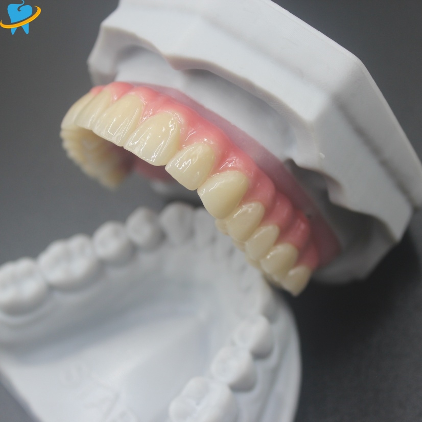 Implant PFM crown