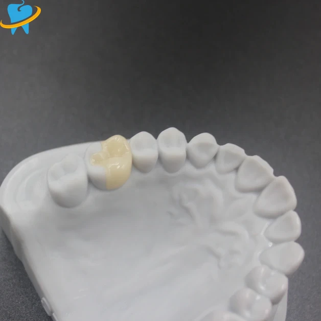 Custom E.max All-Ceramic Dental