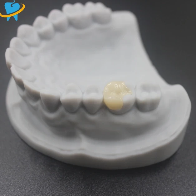 Custom E.max All-Ceramic Dental