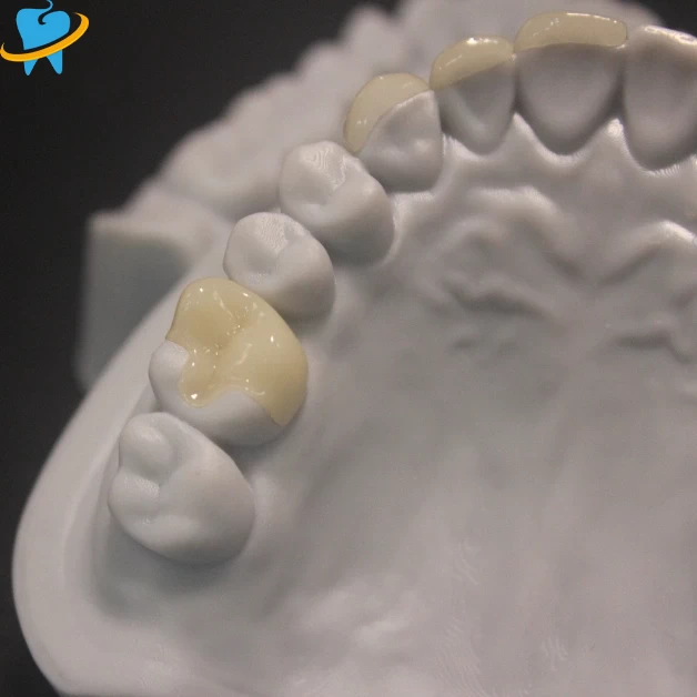 Precision-Fit Restorations Inlay/Onlay Manufacturer