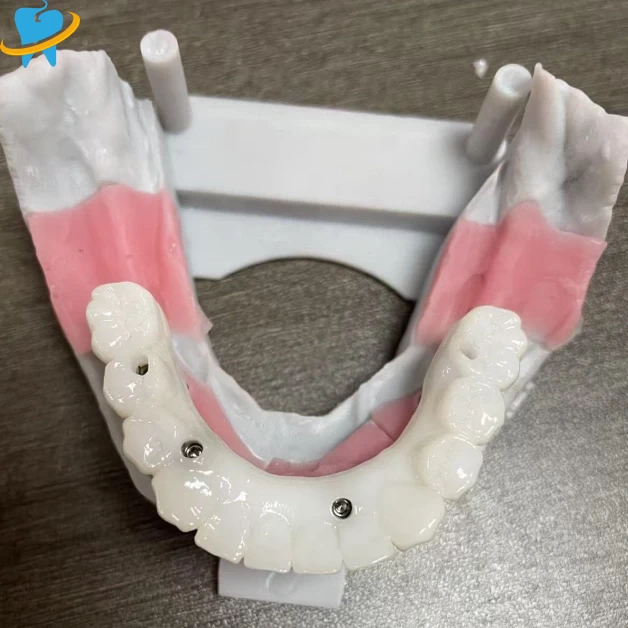 Wholesale Screw Restained Implant Manufacturer 