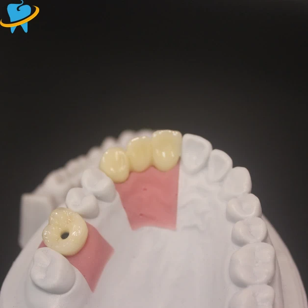 Wholesale Screw Restained Implant Manufacturer 