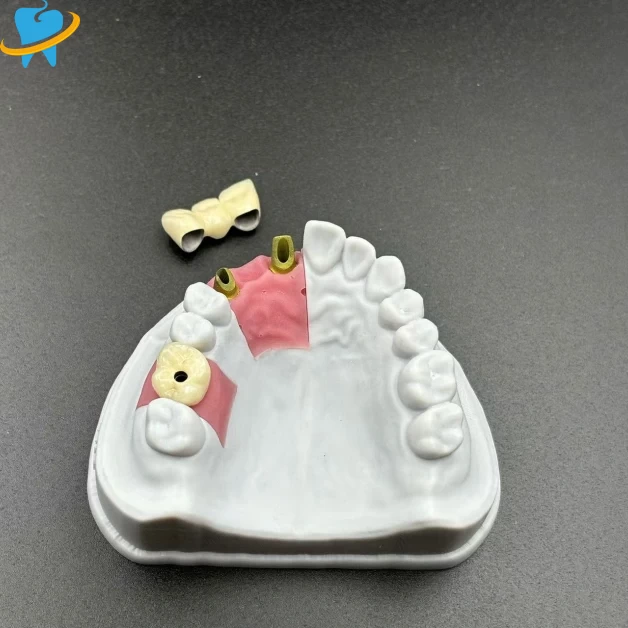 Wholesale Screw Restained Implant Manufacturer 