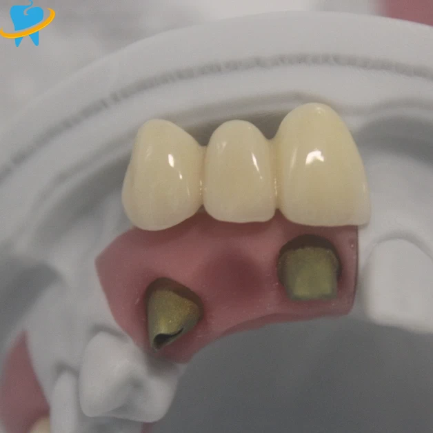 Premium Realistic Full Zirconia Implant Crowns Manufacturer