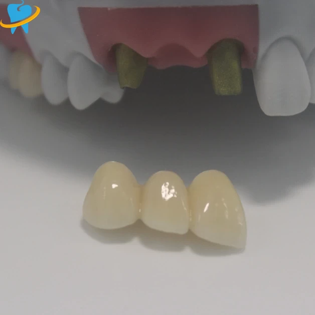 Premium Realistic Full Zirconia Implant Crowns Manufacturer