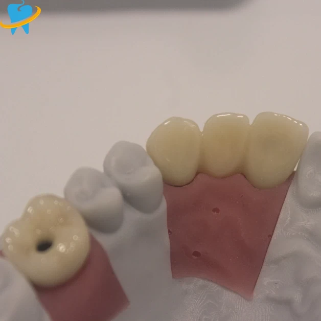 Premium Realistic Full Zirconia Implant Crowns Manufacturer