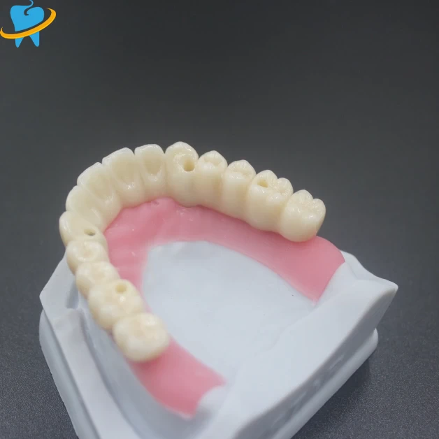 Precision Screw-Retained Implant Dental Lab
