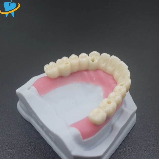 Precision Screw-Retained Implant Dental Lab