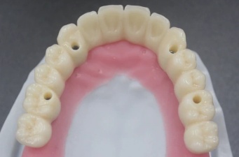 Screw-Retained Implants: The Superior Choice for Dental Restoration