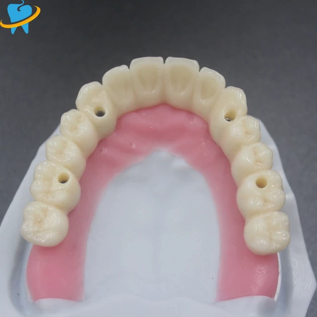 Screw Retained Implant