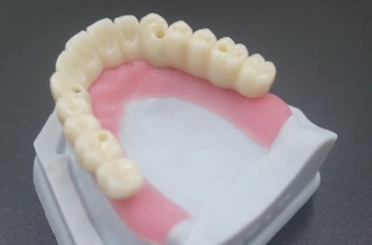Screw-Retained Implants: The Future of Dental Restoration