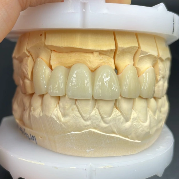Digital Design - Precision-made Full Zirconia Crown