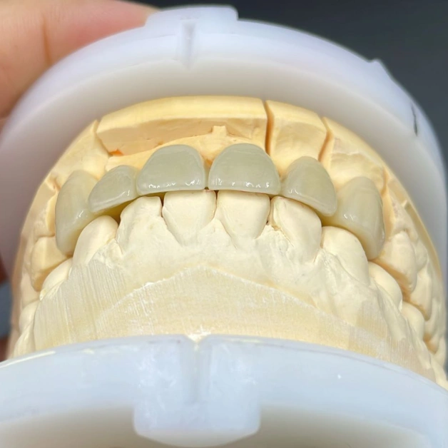 Digital Design - Precision-made Full Zirconia Crown